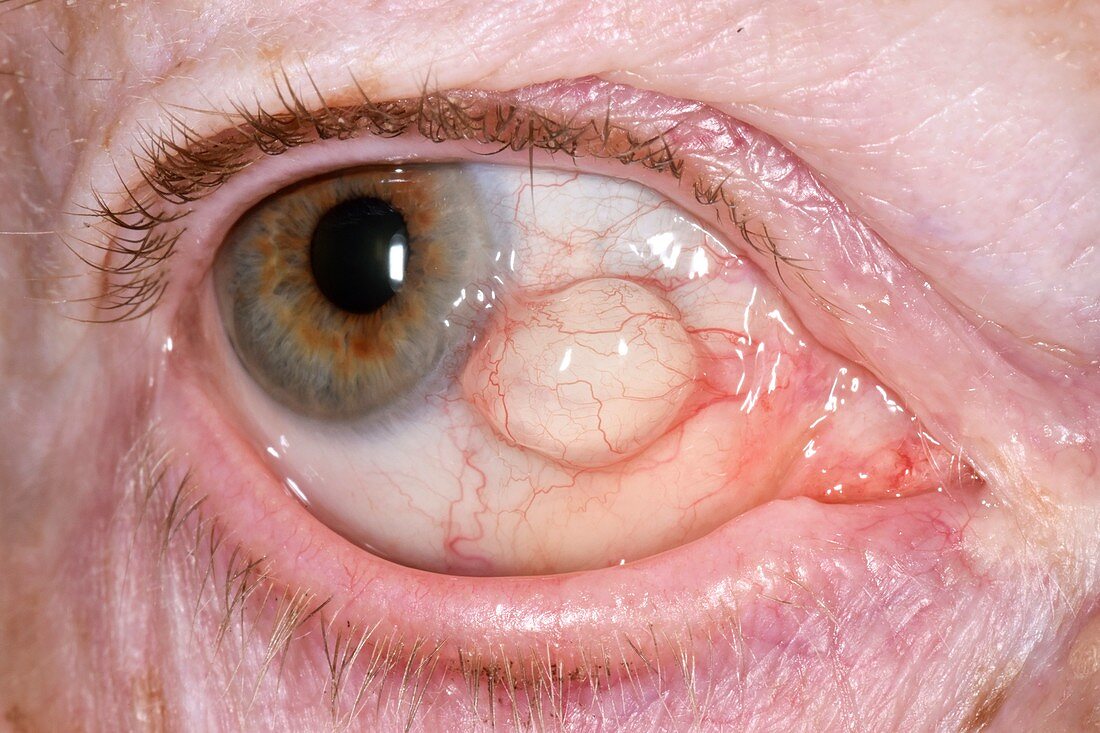 Conjunctival cyst