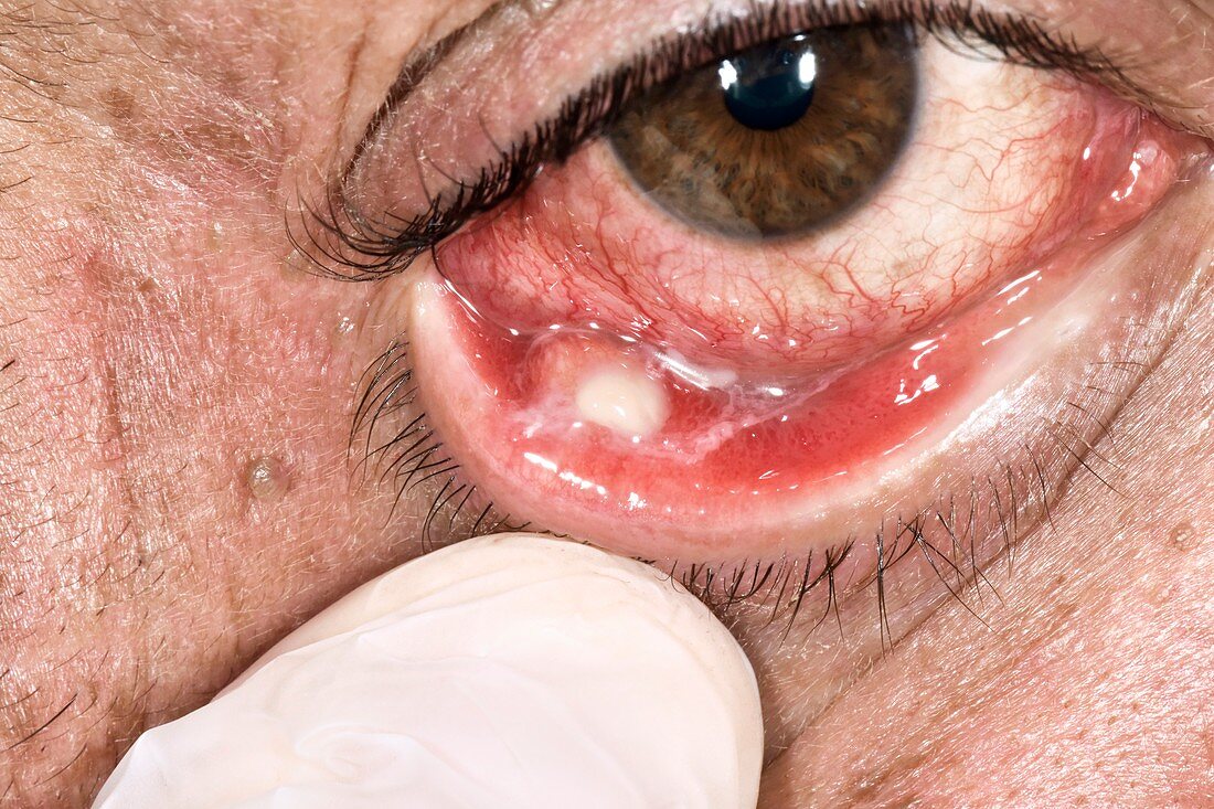 Stye bacterial eye infection