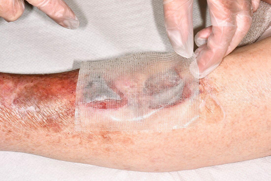Treating a double laceration to shin
