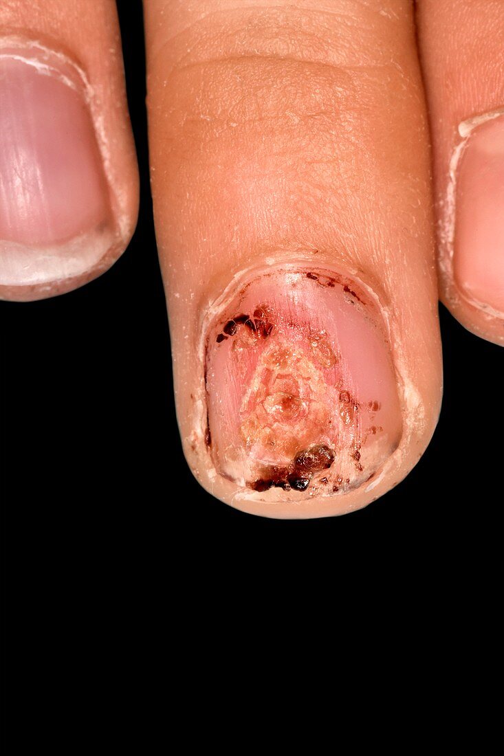 Healing nail injury