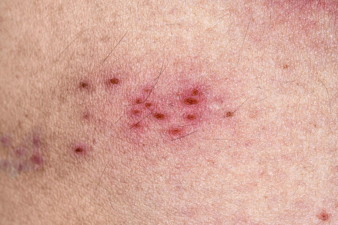 Healing shingles rash