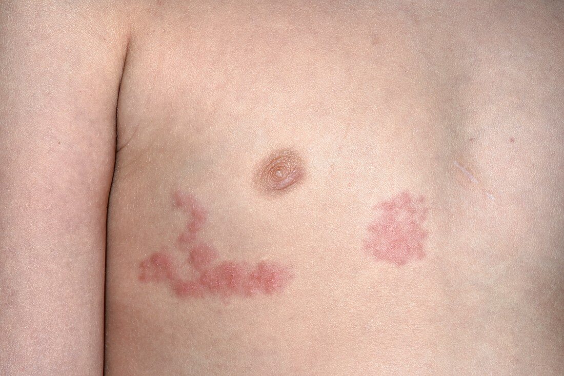 Shingles rash