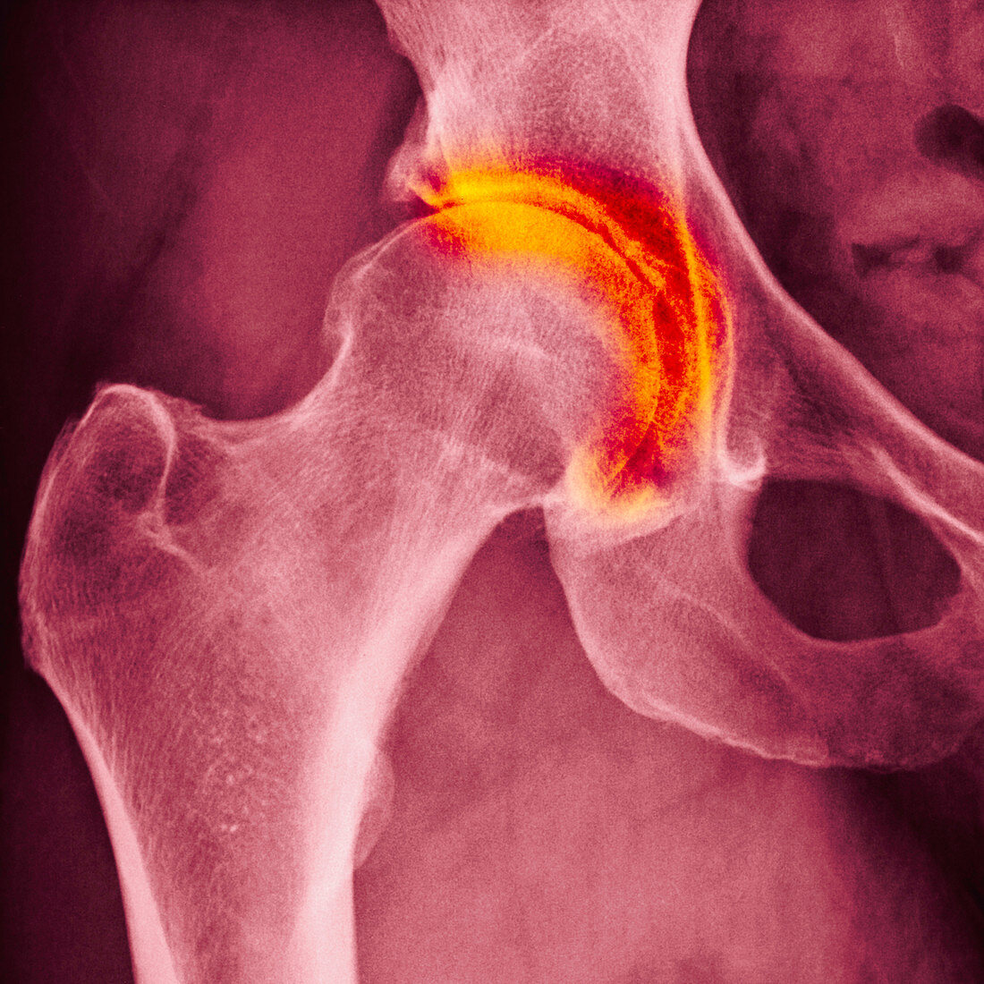 Hip arthritis, X-ray