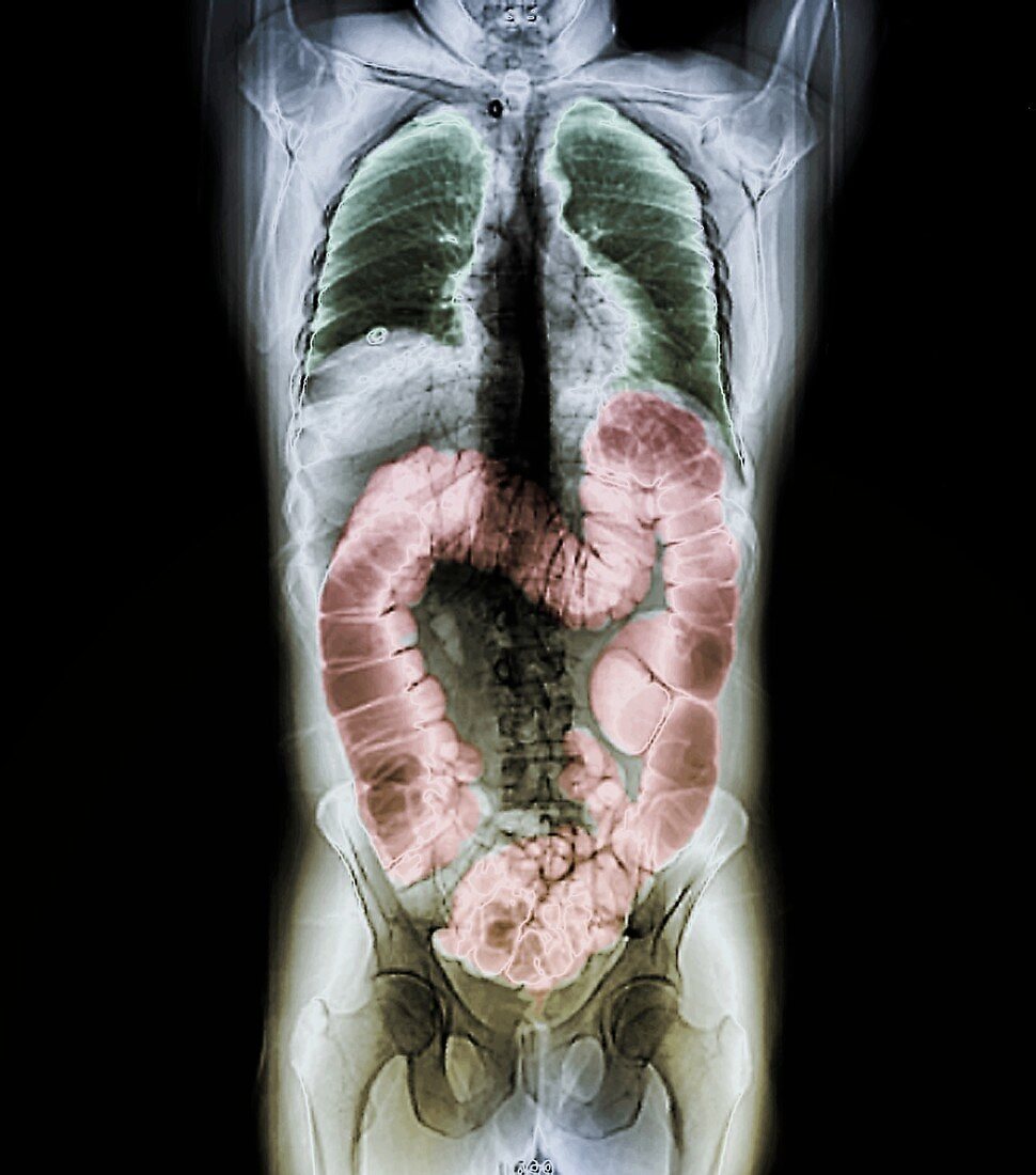 Normal colon, CT scan