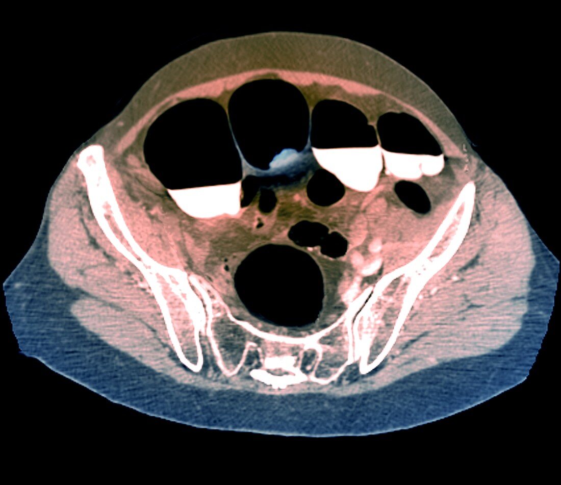 Colon cancer, CT scan