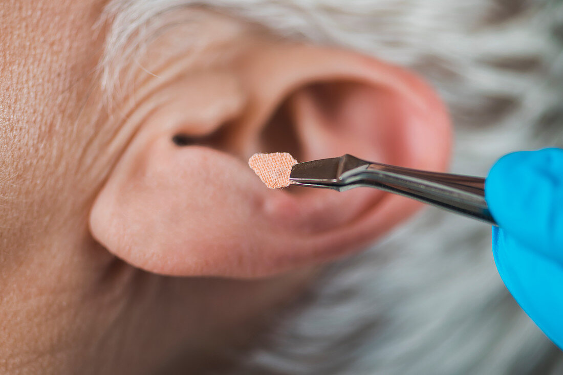 Auricular therapy