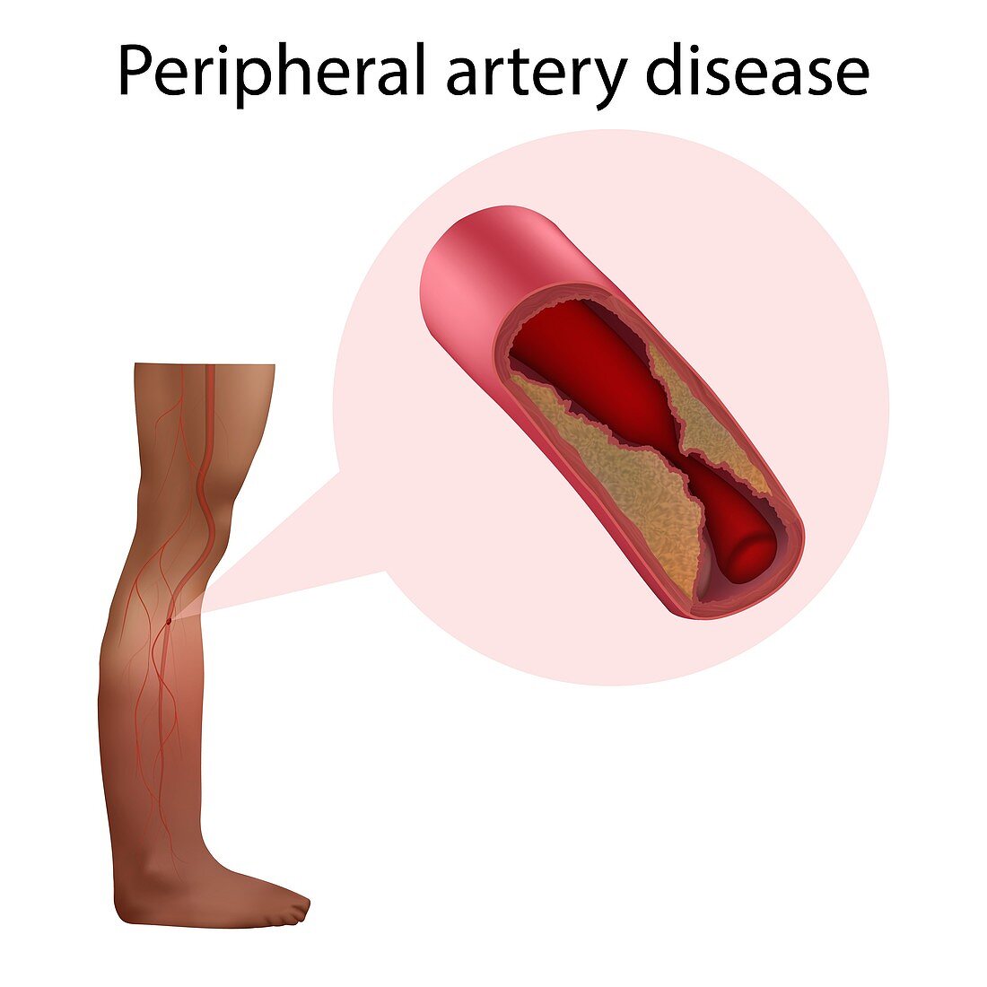 Peripheral artery disease, illustration