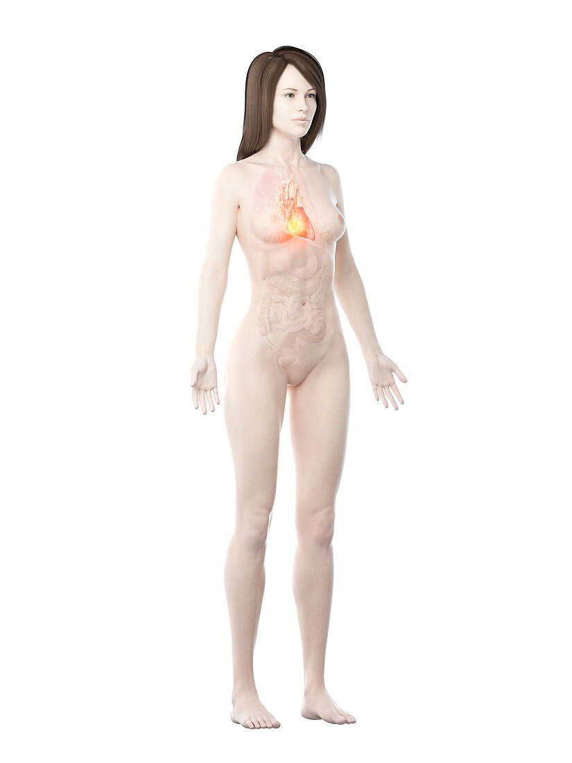 Heart cancer, conceptual computer illustration