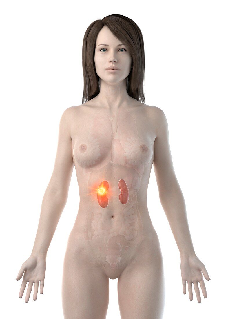 Kidney cancer, conceptual computer illustration