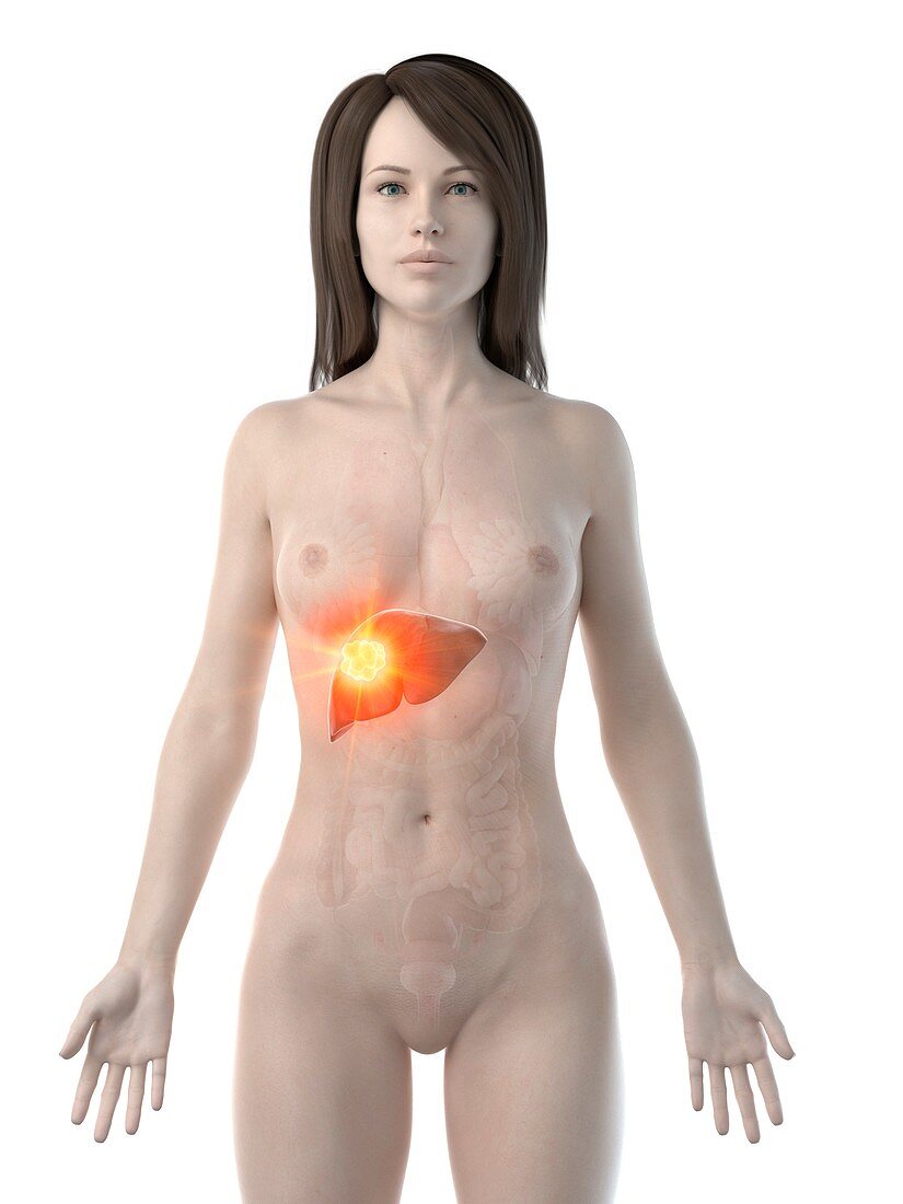 Liver cancer, conceptual computer illustration