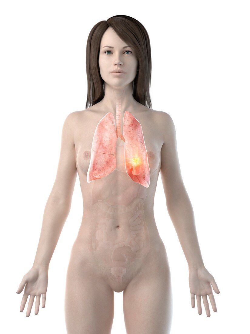 Lung cancer, conceptual computer illustration