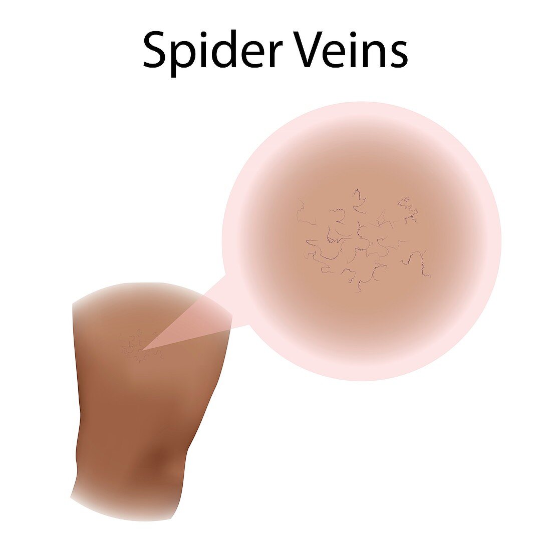 Spider veins, illustration