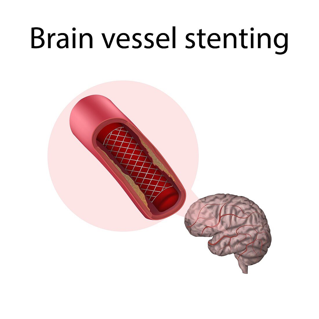 Brain vessel stenting, illustration
