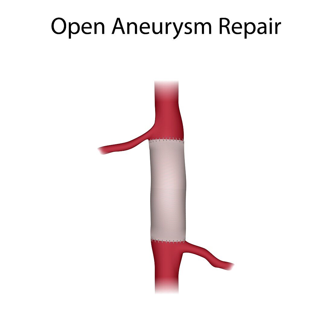 Open surgery aneurysm repair, illustration