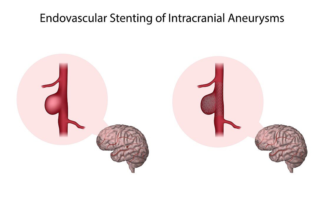 Endovascular stenting of brain aneurysms, illustration