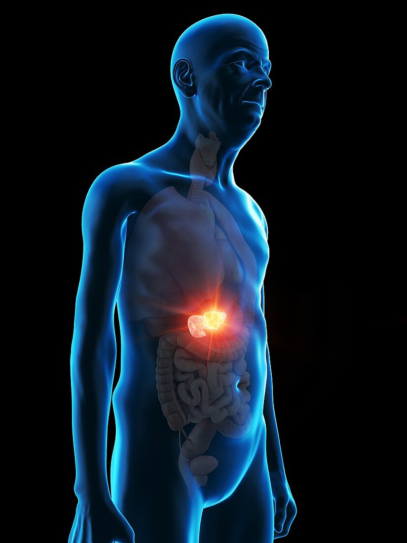 Illustration of an old man's pancreas tumour