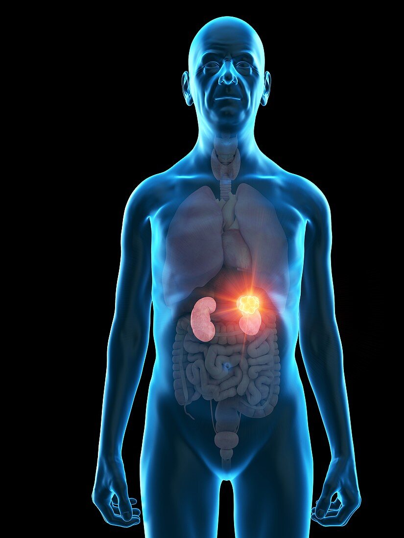 Illustration of an old man's kidneys tumour