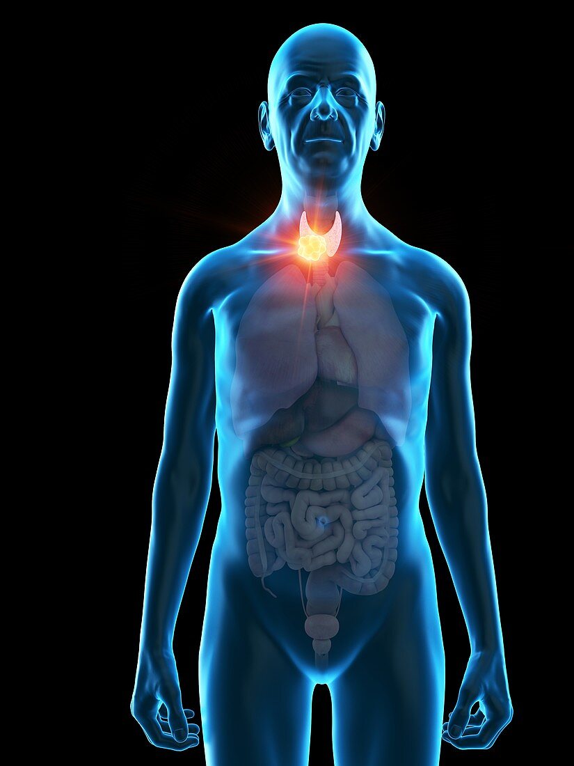 Illustration of an old man's thyroid gland tumour