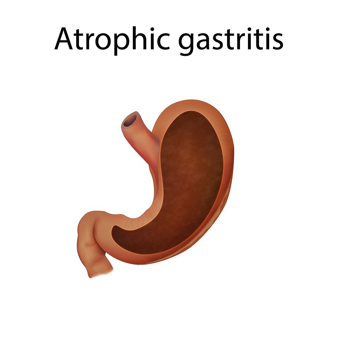 Atrophic gastritis, illustration