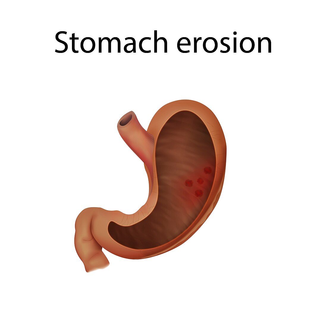 Stomach erosion, illustration