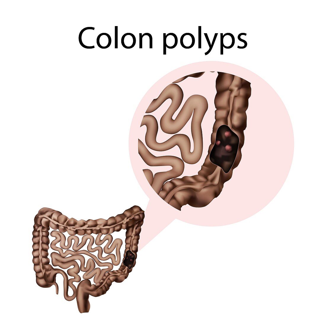 Colon polyps, illustration