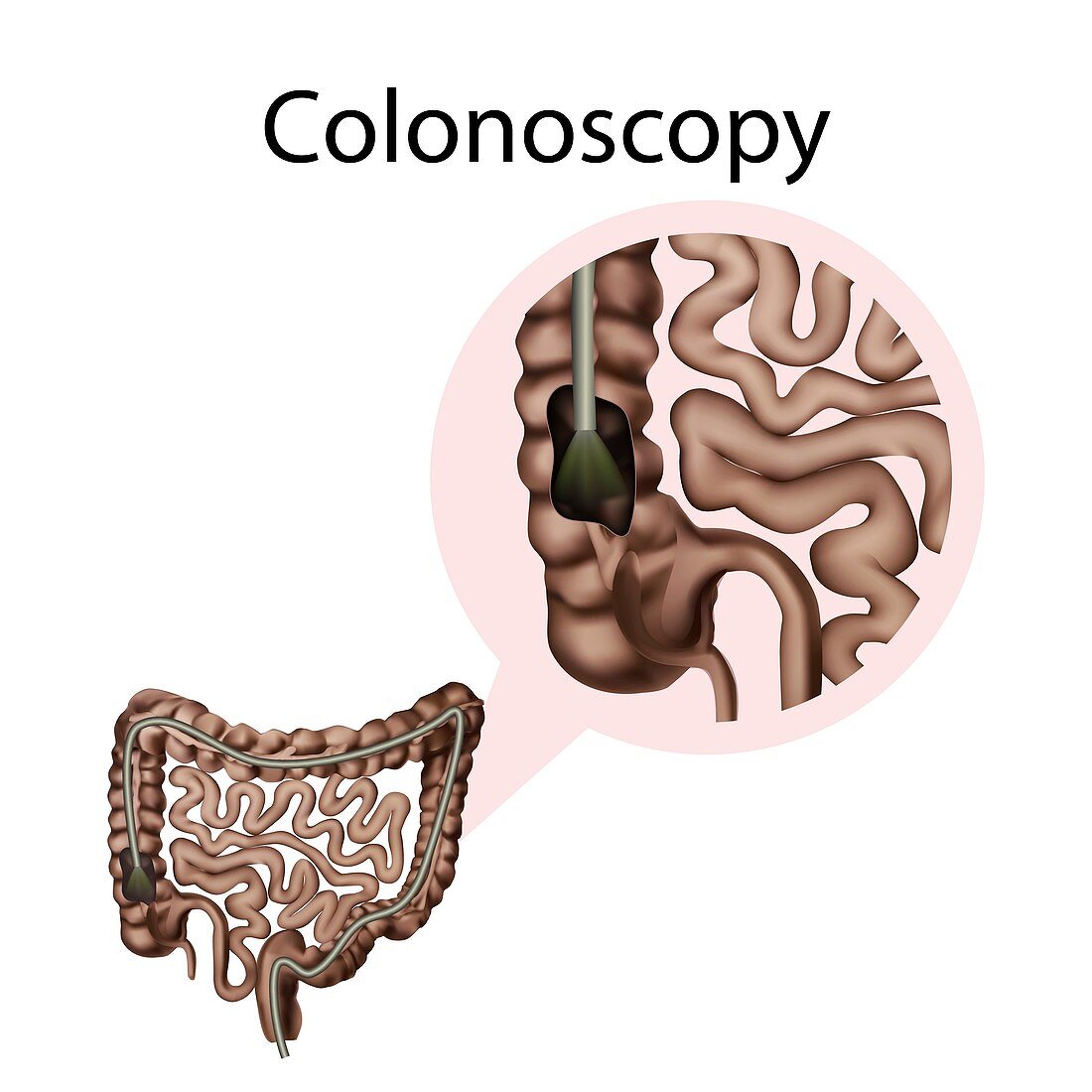 Colonoscopy, illustration