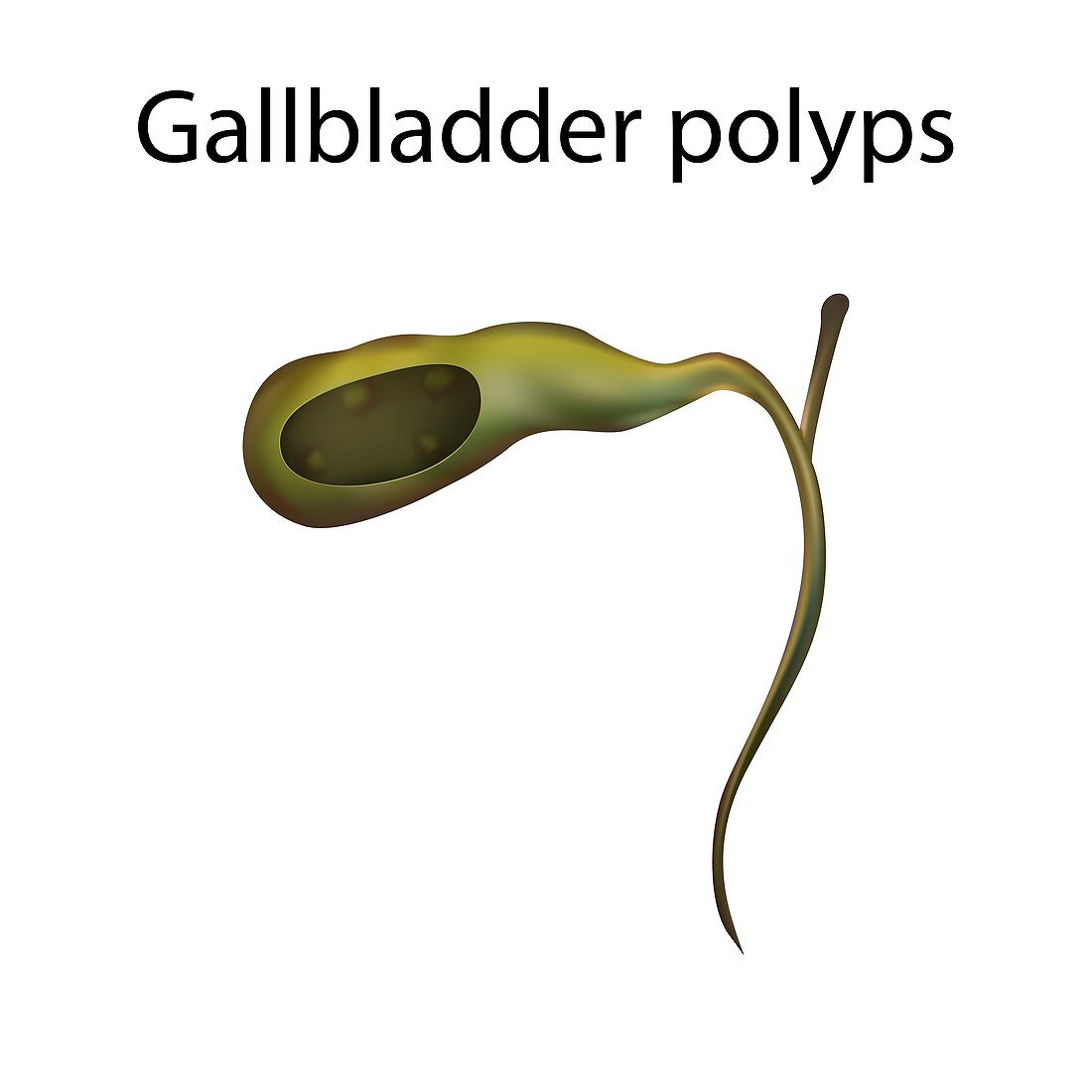 Gallbladder polyps, illustration