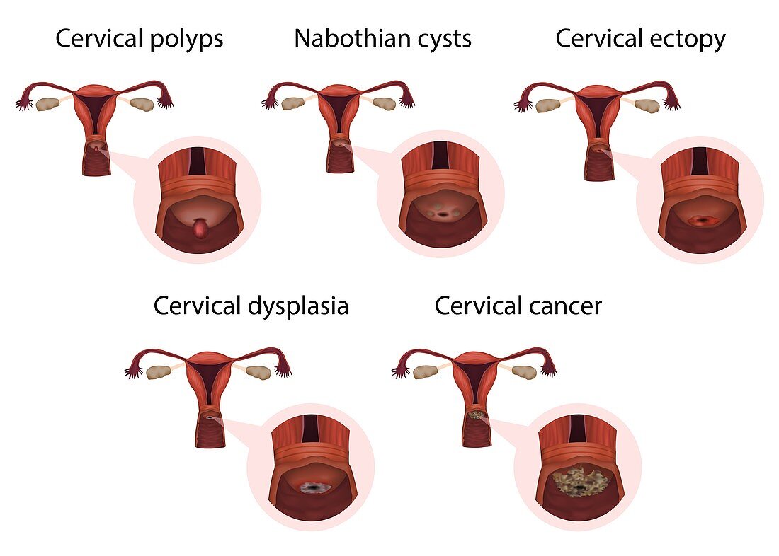 Cervical diseases, illustration