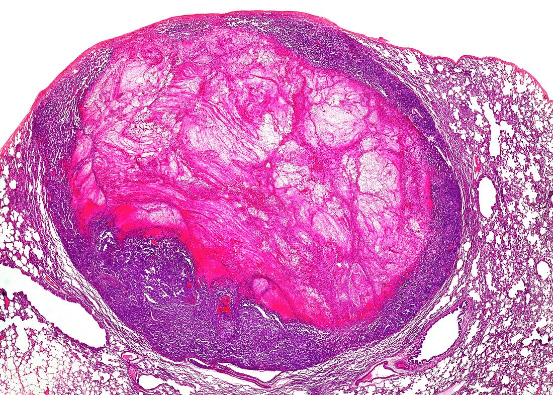 Adenocarcinoma of the lung,light micrograph