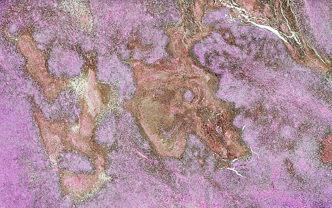 Malignant melanoma,light micrograph