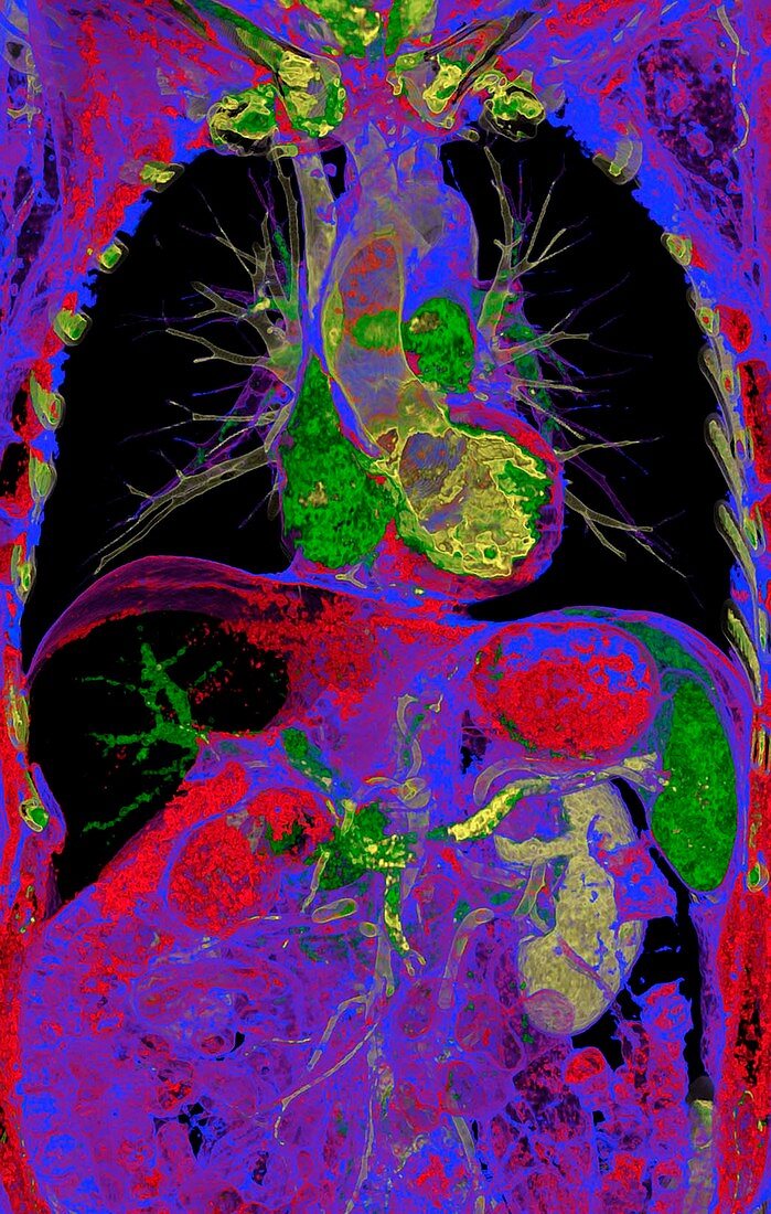 Torso,coloured CT scan