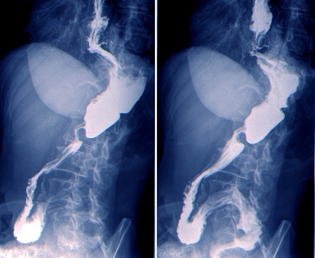 Cancer of the oesophagus,X-rays