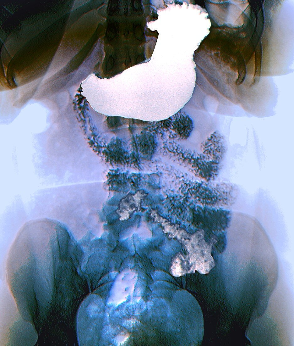 Stomach in bariatric surgery,X-ray