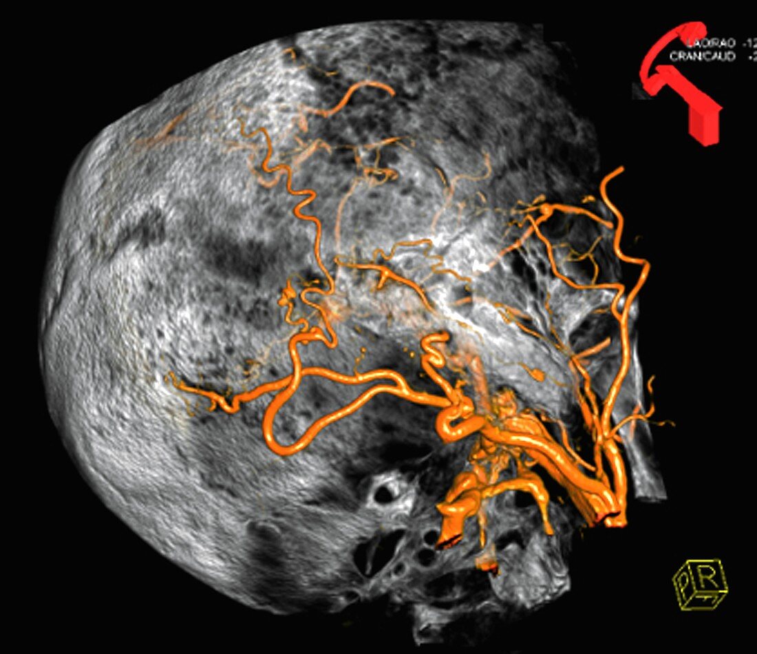 Arterial malformation,3D CT scan