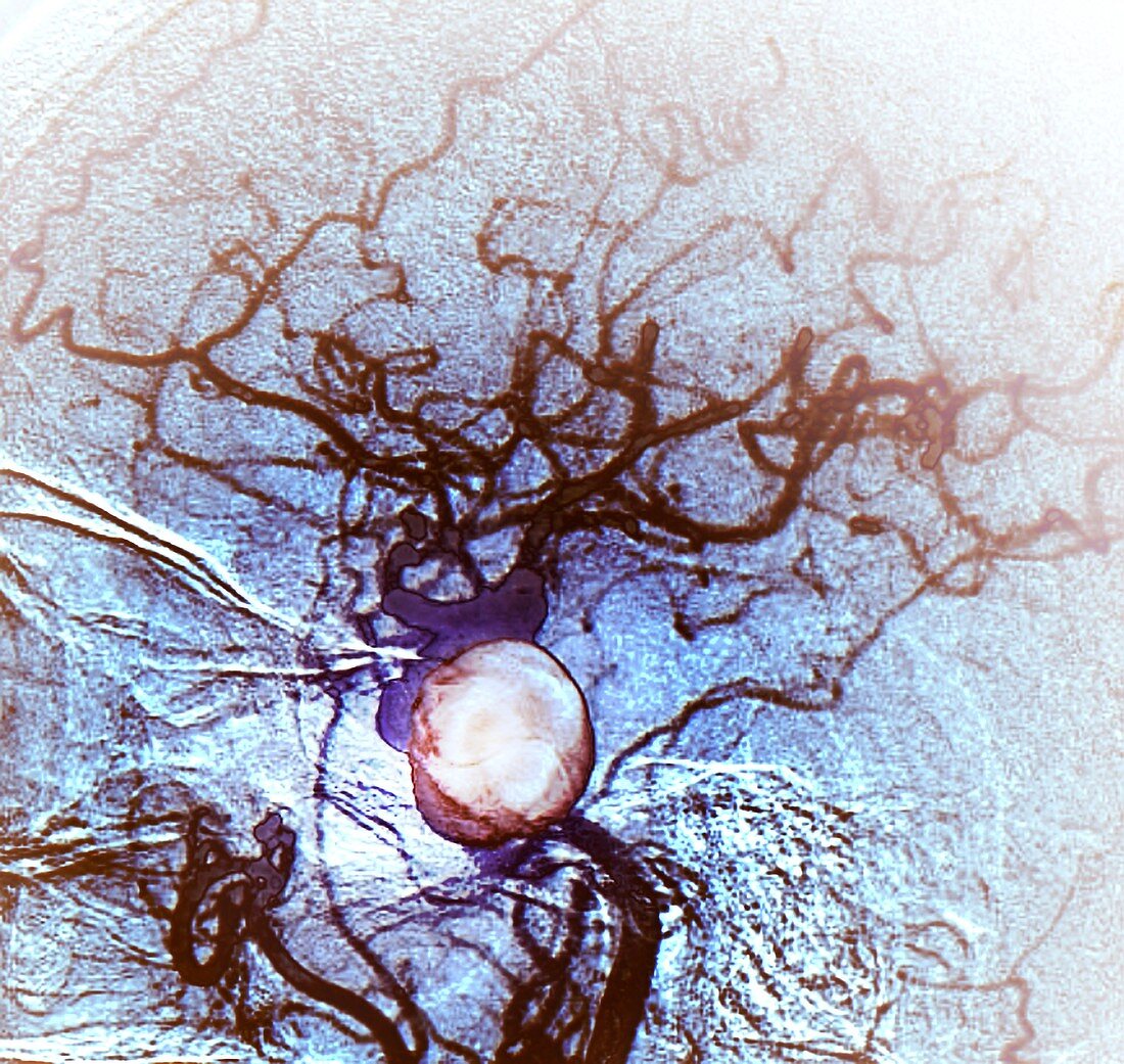 Brain aneurysm,angiogram