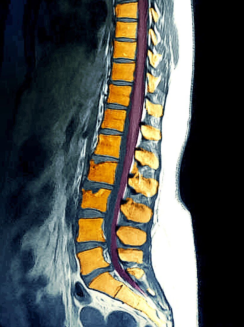 Herniated disks in sciatica,MRI