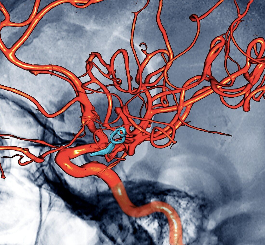 Cerebral aneurysm treatment,3D CT angiogram