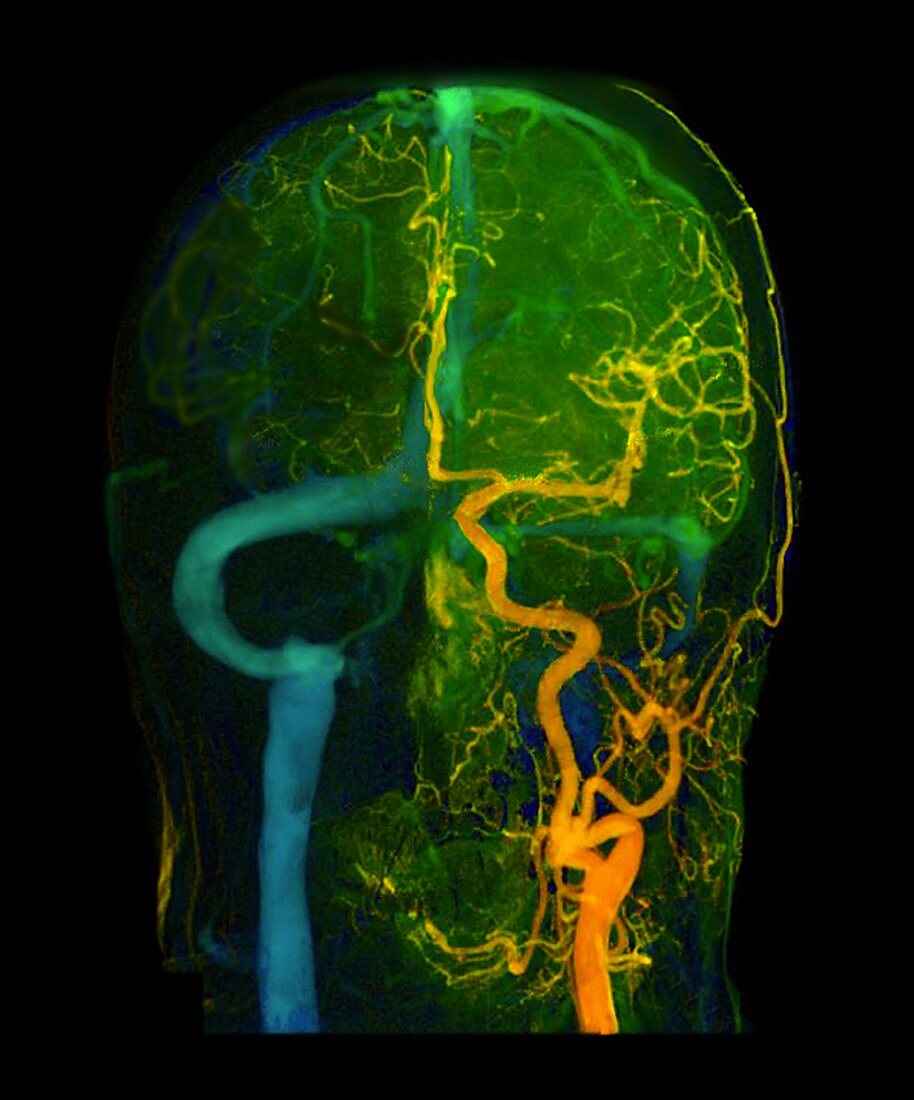 Brain blood vessels,3D angiogram