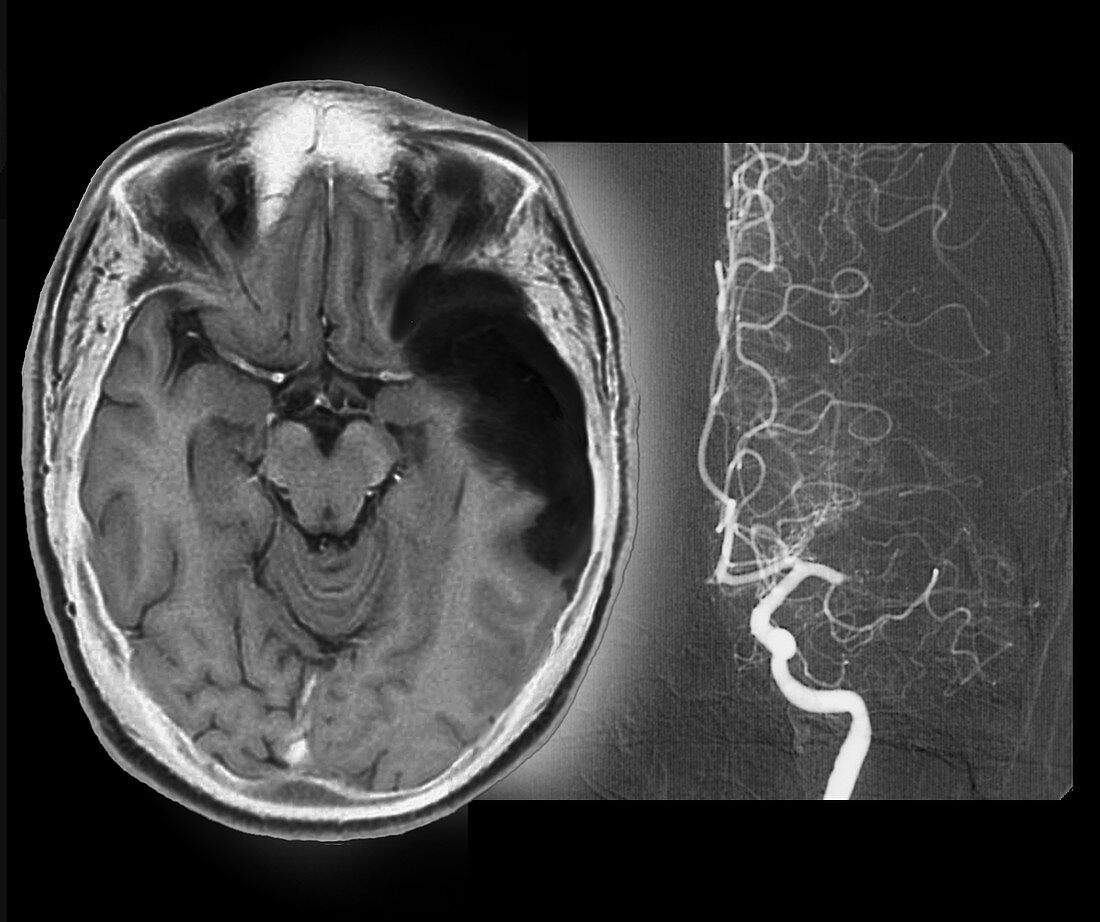 Stroke,MRI brain scan