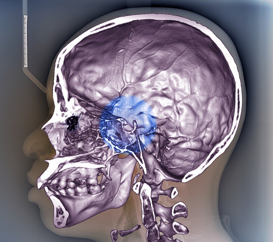 Human skull,3D CT scan