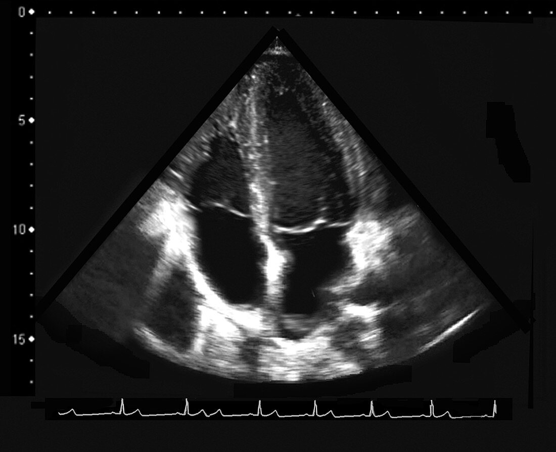 Ventricular enlargement,ultrasound scan