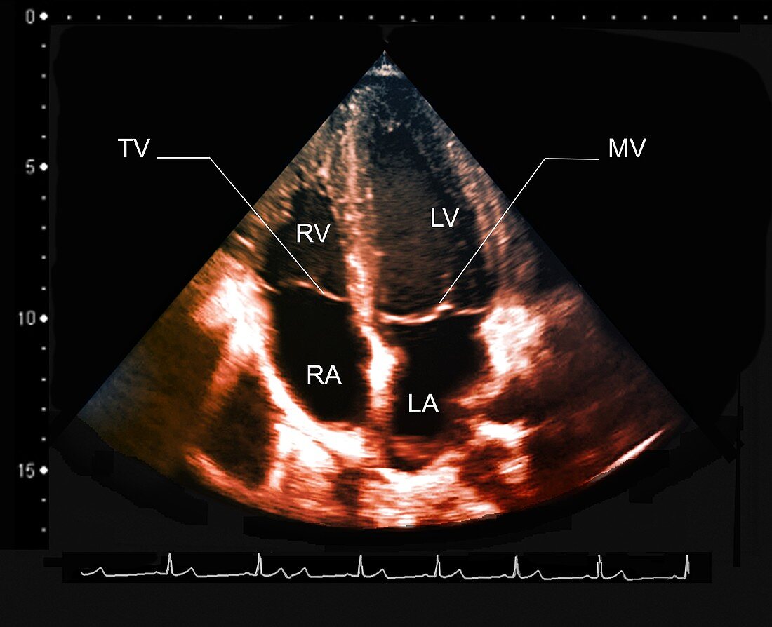 Ventricular enlargement,ultrasound scan