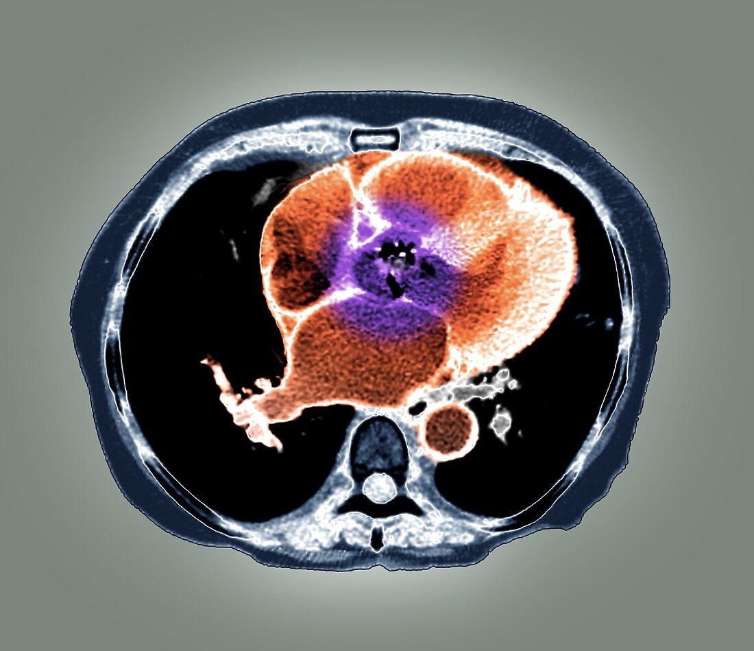 Heart failure,axial CT scan