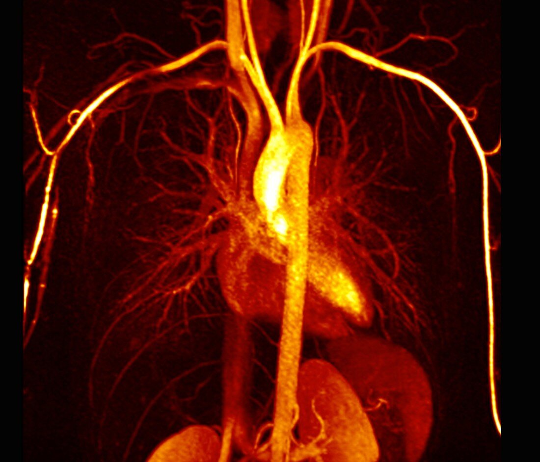 Heart and torso blood vessels,MRI angiogram