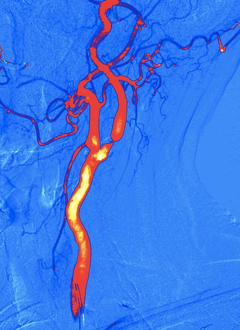 Narrowed carotid artery,digital angiogram