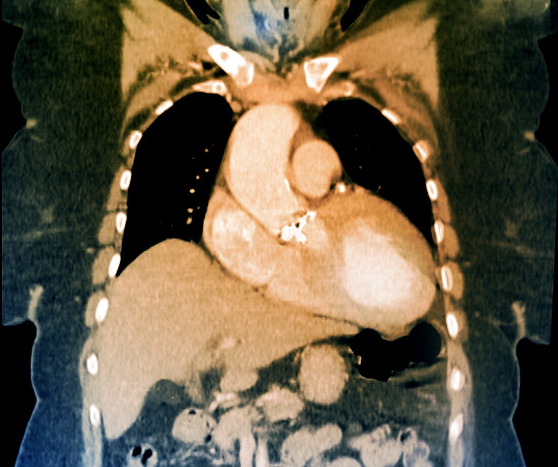 Aortic dilation,coronal CT scan