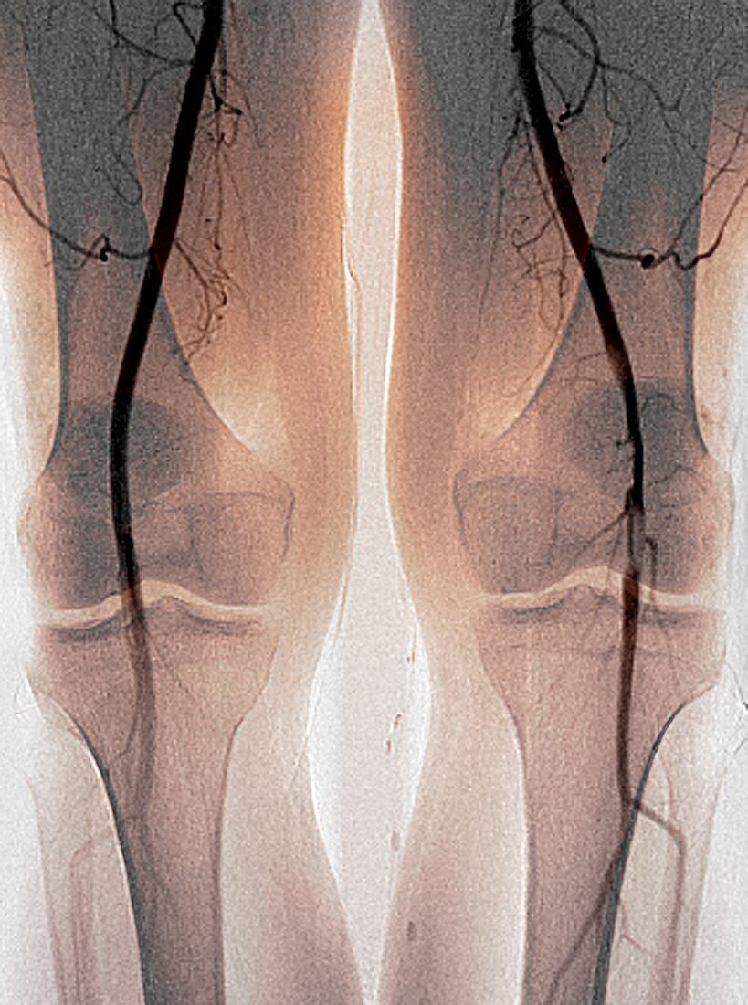Blocked knee artery,angiogram