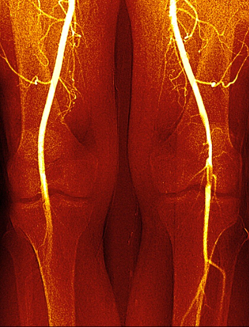 Blocked knee artery,angiogram