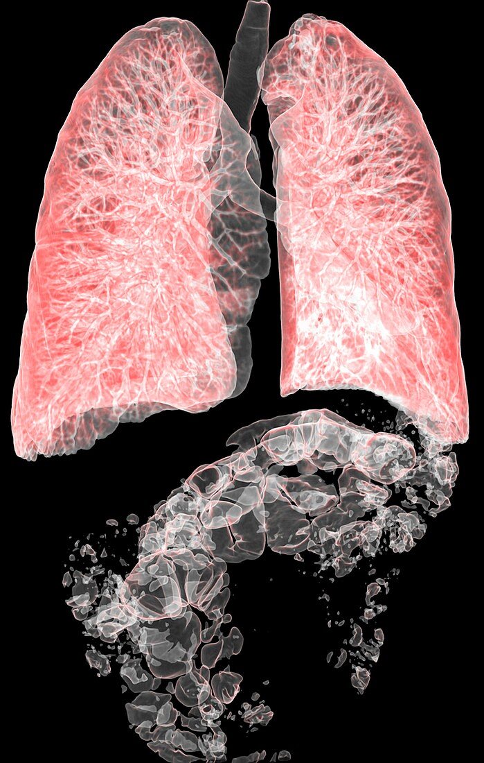 Gas in the lungs and intestines,3D CT scans