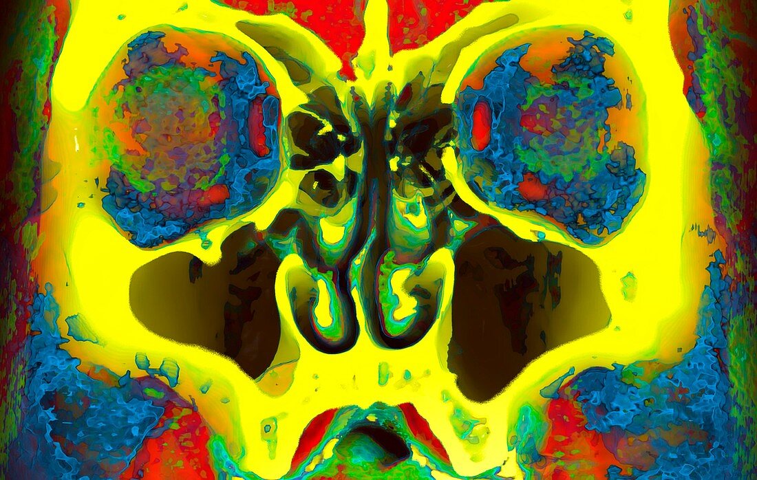 Paranasal sinuses and face,3D CT scan